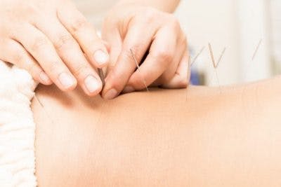 Femme traitant un patient d'AVC avec des aiguilles d'acupuncture et une stimulation électrique