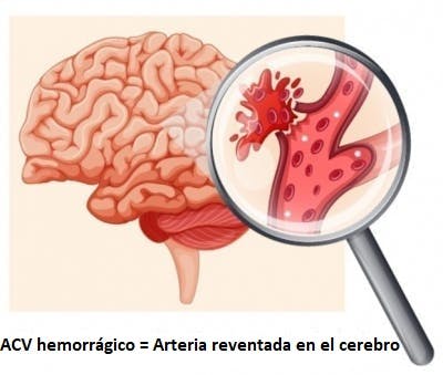 Arteria reventada en el cerebro