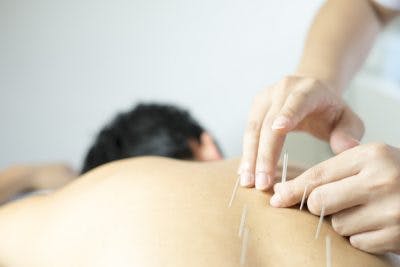 akupunkteur, der am patienten arbeitet