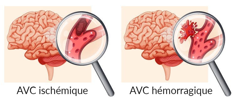 AVC ischémique vs hémorragique