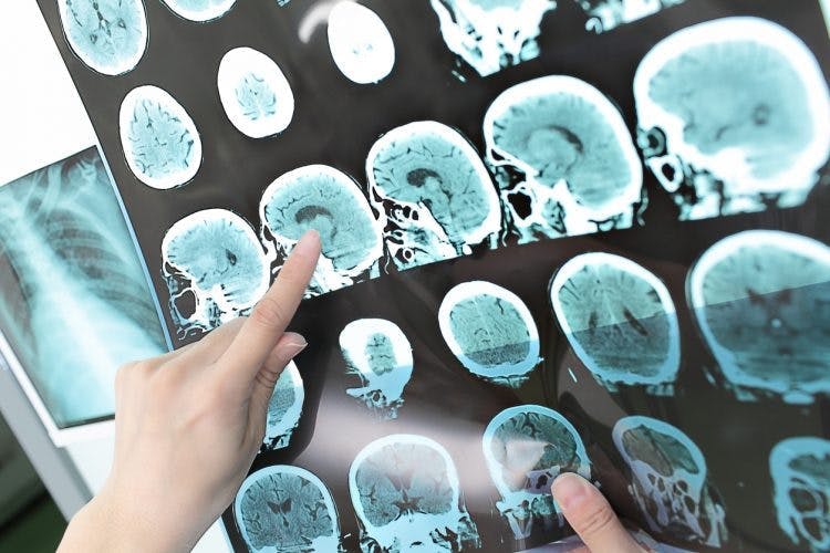 cirugía después de un derrame cerebral
