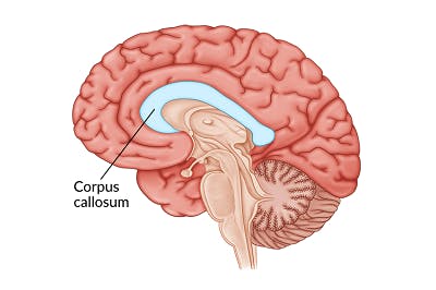 medical illustration of the corpus callosum, a boomerang-shaped structure within the brain vulnerable to injury