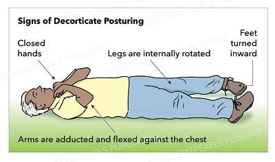 illustration of signs of decorticate posturing after brain injury