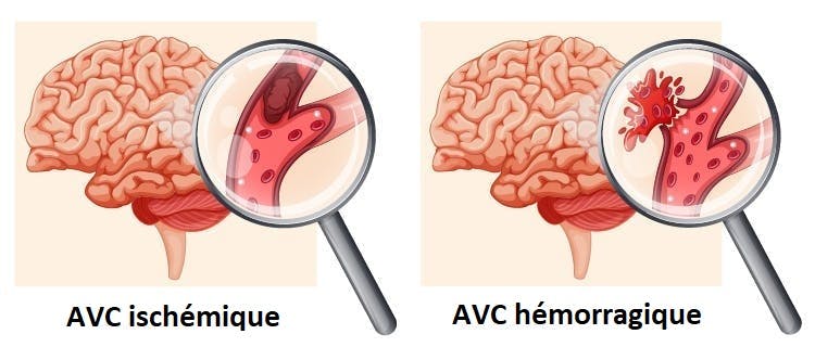diagramme de l'AVC ischémique vs hémorragique