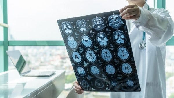 doctor examining a scan of a focal brain injury