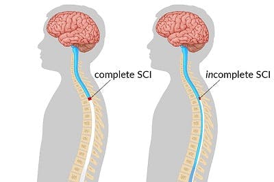 medical illustration of a complete SCI with no signals flowing below the site of injury and an incomplete SCI with partial signals flowing past the site of injury