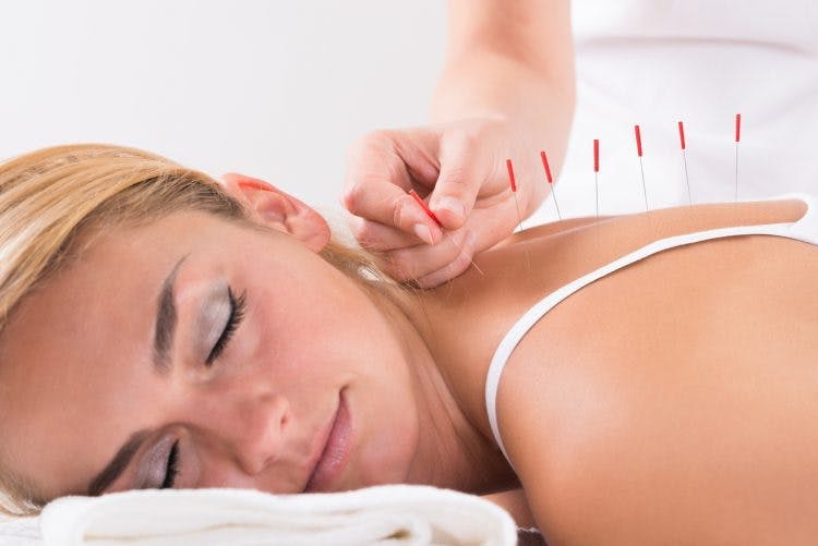 spinal cord injury patient using acupuncture for pain relief