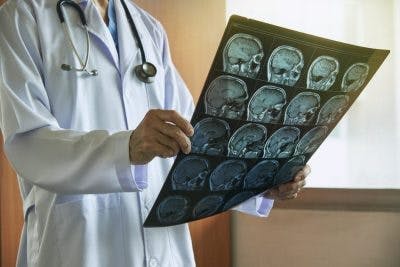 ubicación de accidente cerebrovascular
