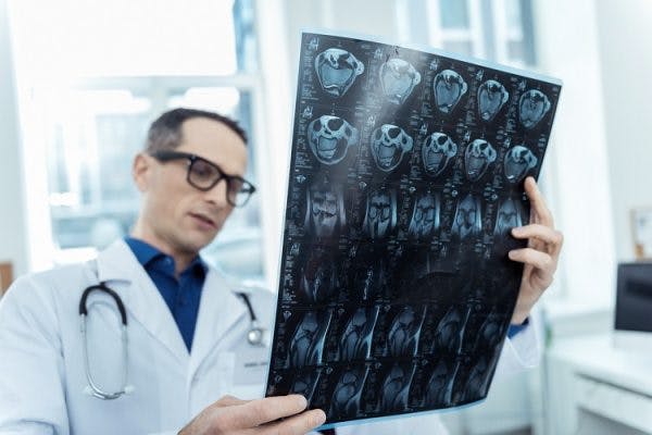 tout ce que vous devez savoir sur la récupération d'un AVC thalamique