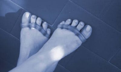 pieds avec séparateurs d'orteils pour aider à fixer les orteils recourbés