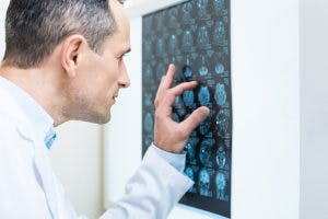 stem cell therapy for stroke patients