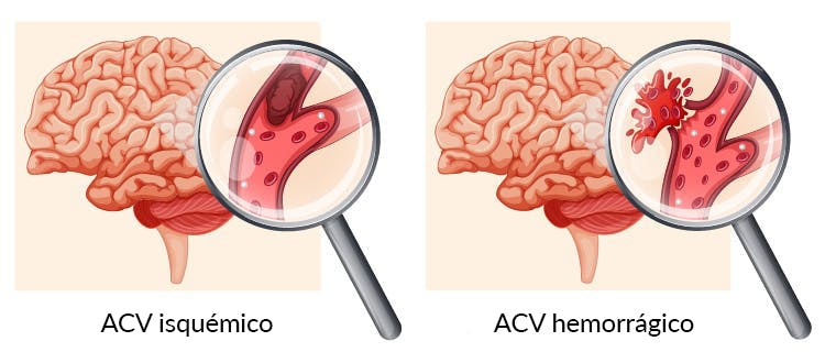 Ilustración del cerebro con accidente cerebrovascular isquémico y hemorrágico del lóbulo occipital
