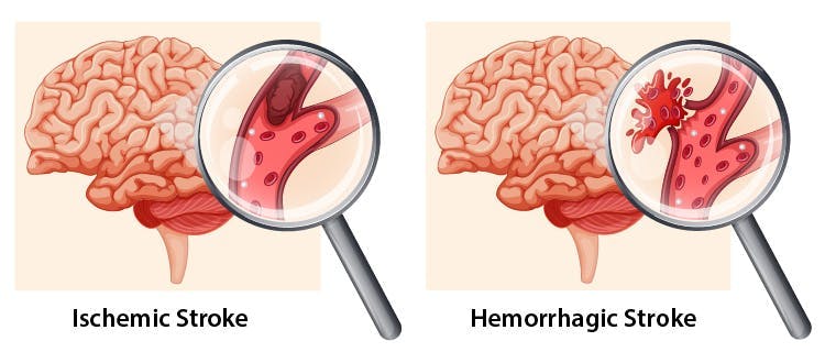 illustration du cerveau avec AVC ischémique et hémorragique du lobe occipital