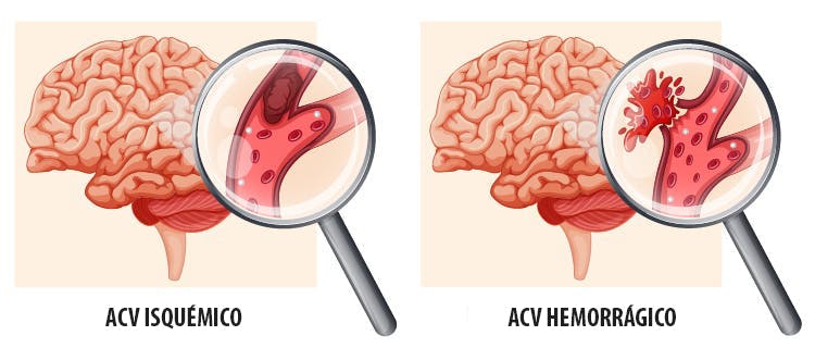  tipos de accidente cerebrovascular severo
