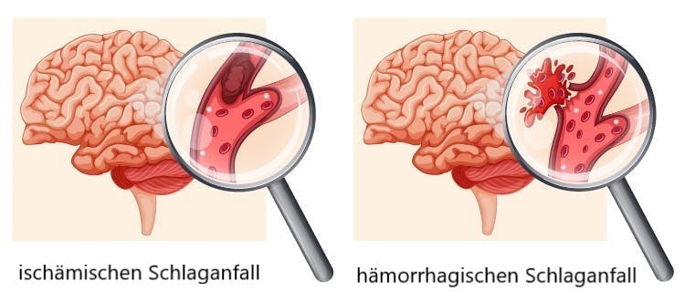 Illustration von ischämischem vs hämorrhagischem Schlaganfall auf der rechten Seite des Gehirns