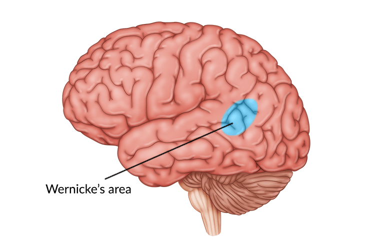 medical illustration of damage to Wernicke's area